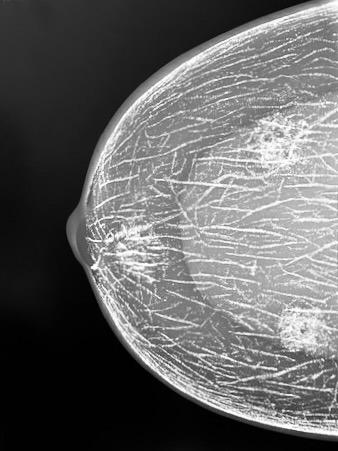 RSD Mammography Phantom with Micro-Calicification Clusters