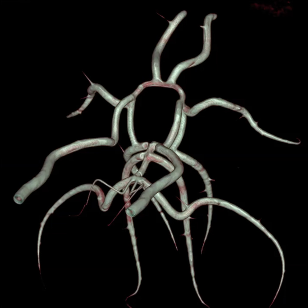 Circle of Willis