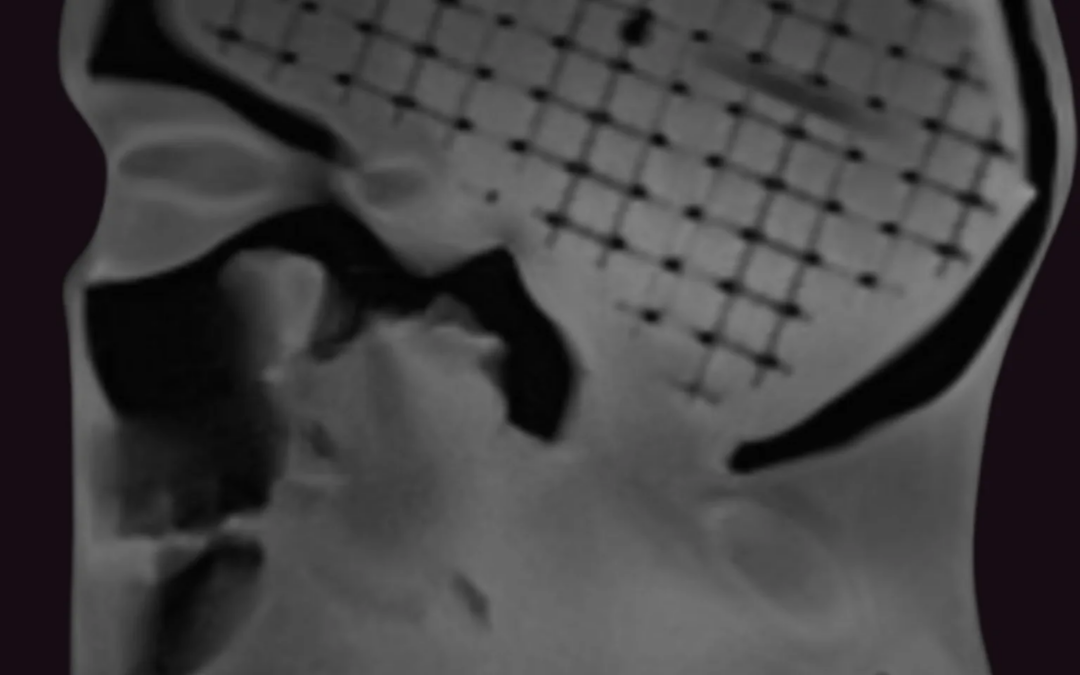 Stereotactic Radiosurgery QA: MRI/CT Fusion